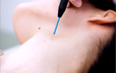 Close-up of a person’s neck during a cosmetic treatment, a blue-tipped handheld device touching the skin for a micro-needling/acupuncture procedure