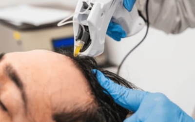 Close-up of a healthcare professional wearing blue gloves using a handheld cosmetic device on a patient's scalp near the hairline.