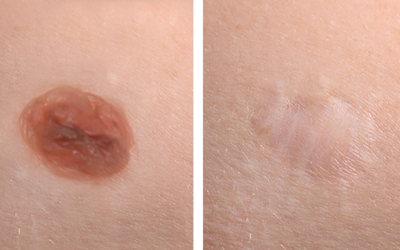 Two close-up skin images showing a raised reddish mole on the left and a pale healed scar on the right (before and after treatment).