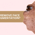 How to Remove Face Hyperpigmentation