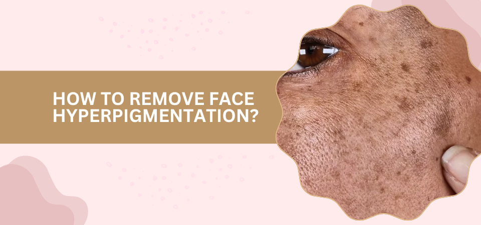 How to Remove Face Hyperpigmentation