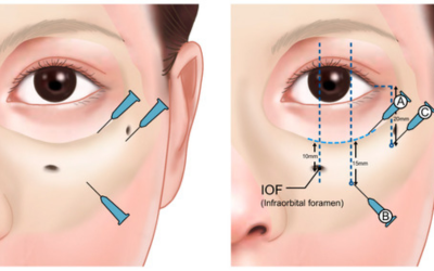 Two-panel medical diagram: left panel shows periocular injection needles around the lower eyelid; right panel maps infraorbital anatomy with the infraorbital foramen and labeled points A, B, C and projected injection paths.