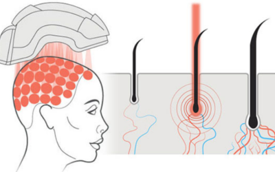 Head with a helmet-like device; scalp cross-section shows hair follicles and underlying blood vessels during a procedure.