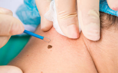 Dermatologist in blue gloves using a small instrument near a mole on the back of a person's neck.
