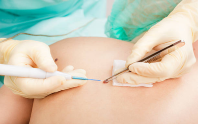 Medical professionals wearing gloves perform a minor skin procedure on a patient’s abdomen using a syringe and scalpel.