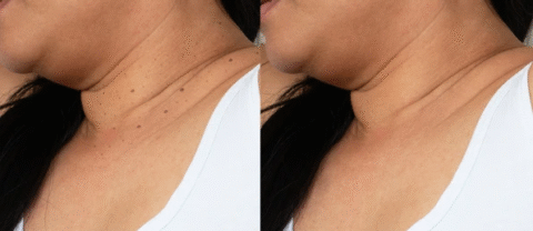 cosyt-1-480x226 Side-by-side comparison of a woman's neck and lower face before and after skincare treatment, showing smoother skin on the right.