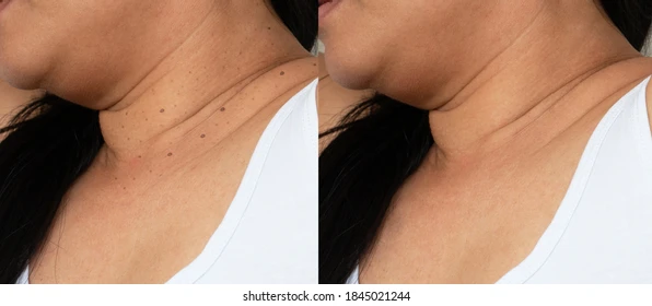 Side-by-side before-and-after comparison of a woman's neck showing reduced sagging and wrinkles after a skin treatment.