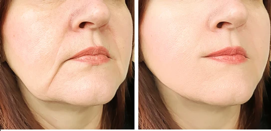 Before-and-after close-up of the lower face showing smoother skin and fewer wrinkles after treatment (left: before, right: after).