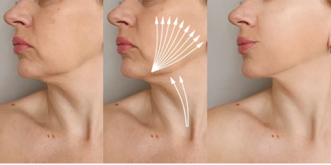Triptych of a woman's profile (neck to chin): left shows before, middle shows lifting arrows over the neck area, right shows after results.
