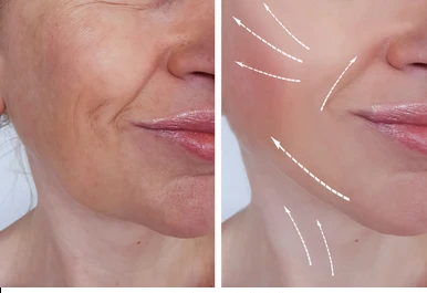 Before-and-after side-by-side photo of a woman's lower face showing wrinkle reduction; arrows on the right indicate lifted, smoother skin after treatment.