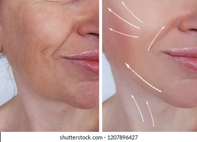 Side-by-side: left panel shows a woman's lower face with deep wrinkles; right panel shows smoother skin with white arrows indicating lifted areas.