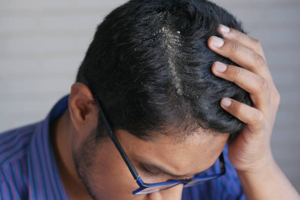 Man with dark hair and glasses runs hand through his hair, exposing a thinning scalp at the crown.