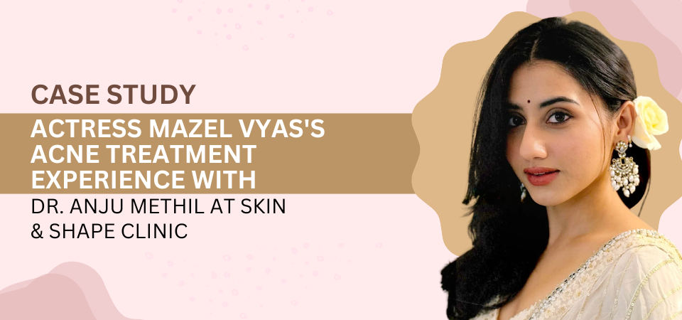 Case study banner featuring actress Mazel Vyas discussing acne treatment with Dr. Anju Methil at Skin & Shape Clinic, shown beside her portrait.