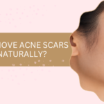 How to Remove Acne Scars from Face Naturally