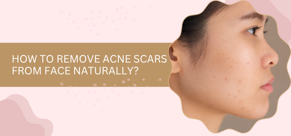 How to Remove Acne Scars from Face Naturally