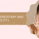 Is Vitiligo Hereditary and What Causes It