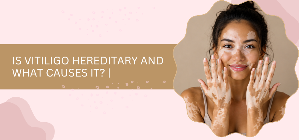 Is Vitiligo Hereditary and What Causes It