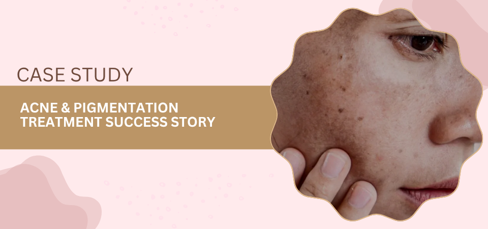 Case study hero image: close-up of a cheek with acne scars, overlaid by a tan banner that reads 'ACNE & PIGMENTATION TREATMENT SUCCESS STORY' on a pink background