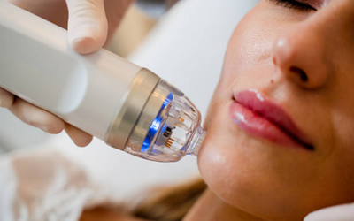 Microneedling Radiofrequency (MNRF) Close-up of a handheld skincare wand applying treatment to a woman's cheek during a facial.