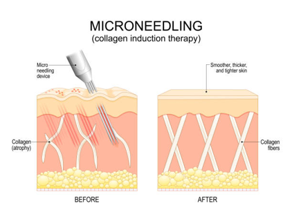 Picture1 Diagram of microneedling showing 'Before' and 'After' skin: left panel with micro-needling device creating channels and collagen atrophy; right panel shows thicker, smoother skin with aligned collagen fibers.