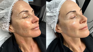 Picture3 Side-by-side before and after of a woman's face showing reduced redness and smoother skin after a facial treatment.