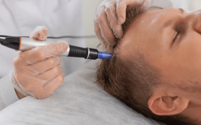 Scalp MNRF for Hair Loss Close-up of a clinician wearing gloves using a pen-like device on a man's scalp during a hair treatment.