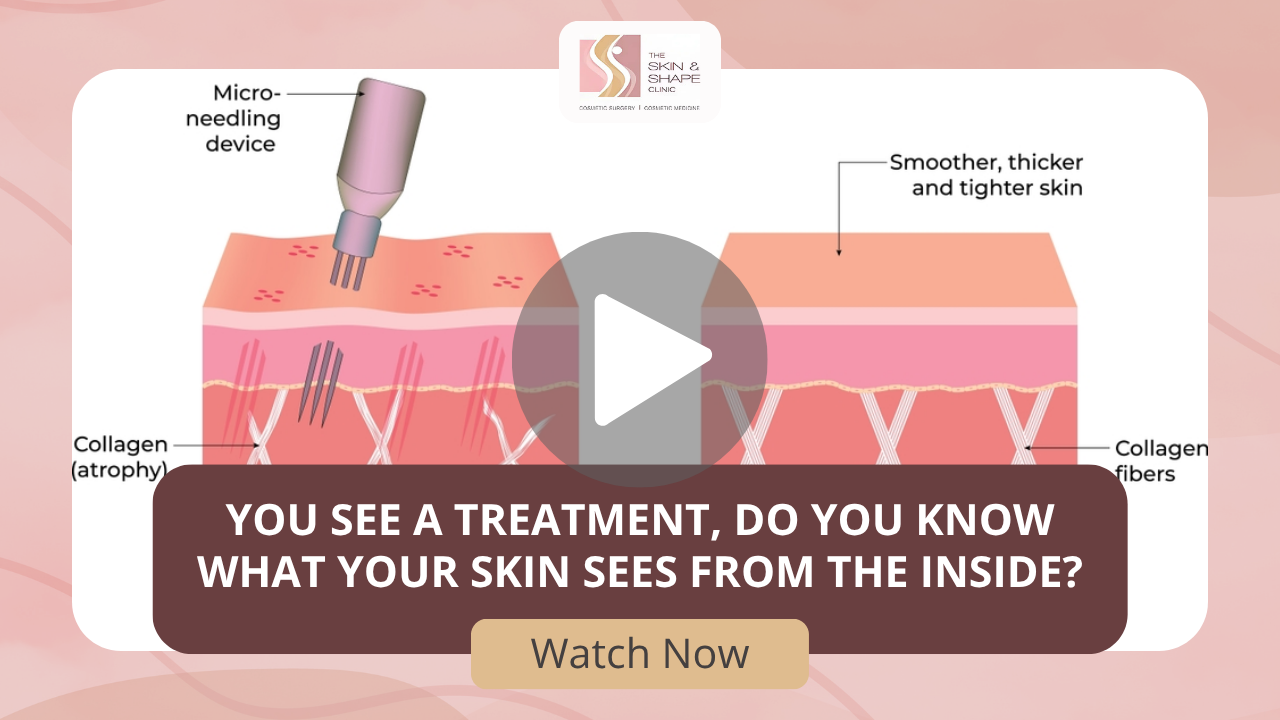 Educational cross‑section of skin showing a micro‑needling device penetrating the surface to stimulate collagen, with labeled collagen fibers and the result of smoother, thicker skin.