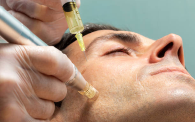 â_¢ Microneedling with Skin Boosters Close-up of a clinician injecting facial fillers into a patient’s face, syringe and gloved hands visible near the eye and forehead area.