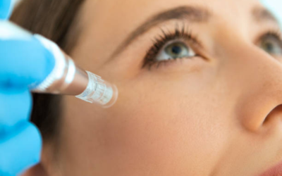 â_¢ Standard Microneedling (Dermapen-based) Close-up of a woman's face during a cosmetic facial injection, with a syringe near her cheek.