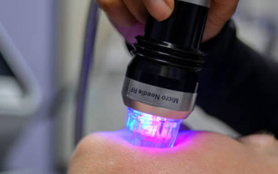 â_¢ Step 5_ Precision needling or MNRF pass Close-up of a handheld LED light therapy device emitting blue-violet light onto the skin during treatment.