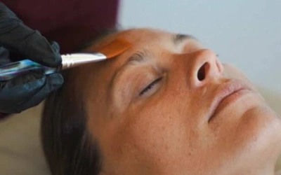 3. Skin Preparation Close-up of a woman receiving a cosmetic facial treatment; a gloved practitioner uses a handheld device near her temple/eyebrow area.