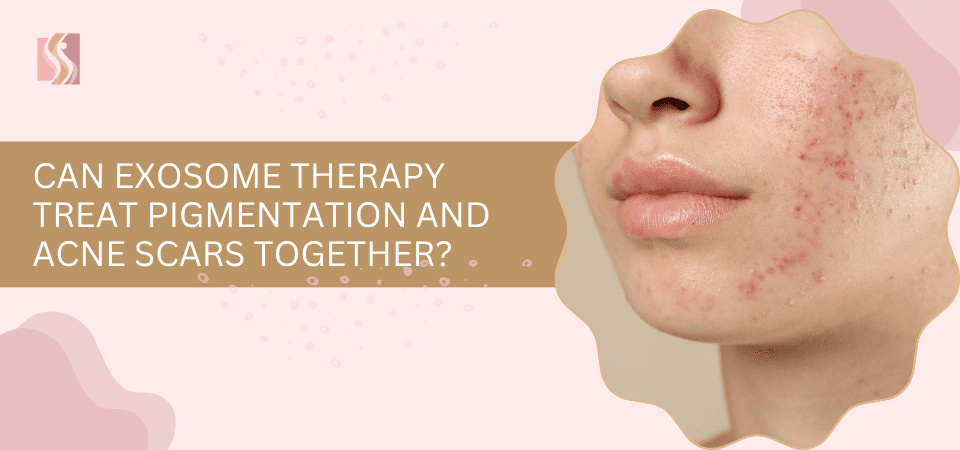 Can Exosome Therapy Treat Pigmentation and Acne Scars Together