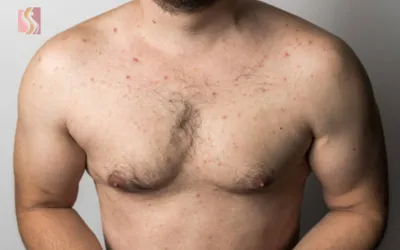 Bare chest of a man with acne on the chest and shoulders, facing the camera.