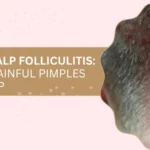 Banner on chronic scalp folliculitis: causes of painful pimples on the scalp with a close-up inflamed scalp on the right.
