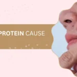 Headline reads 'Does whey protein cause acne?' beside a close-up image of a cheek with acne being pinched.