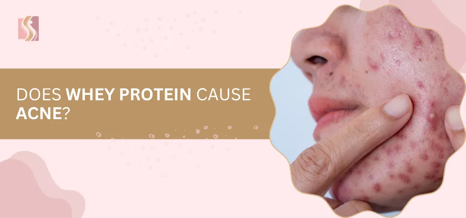 Headline reads 'Does whey protein cause acne?' beside a close-up image of a cheek with acne being pinched.