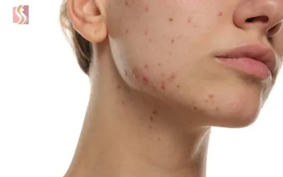 Close-up of a young person’s jawline and chin with red acne pimples on the skin on the lower face.