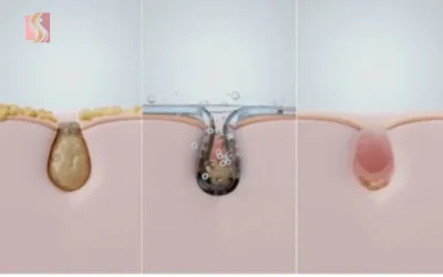 Cross-section of skin showing three hair follicles: clogged pore with sebum left, blackhead center, and open pore right.