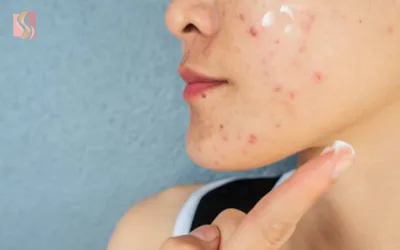 Close-up of a person’s cheek and chin showing red acne lesions, with a finger lightly touching the jawline using a cotton pad.