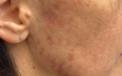 â___Exosome Therapy for Acne Scars Close-up of a person's cheek with red acne scars and uneven skin texture, ear partially visible on the left.