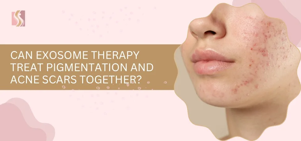 Promotional banner about exosome therapy for pigmentation and acne scars, with a close-up of a cheek showing acne lesions.