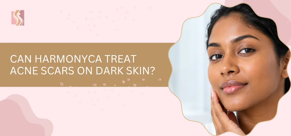 Can HArmonyCa Treat Acne Scars on Dark Skin